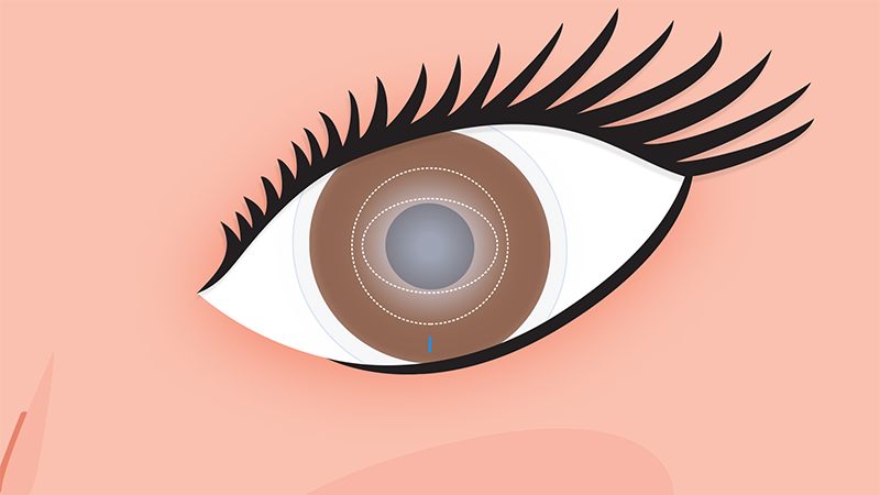 Optimized Toric Lens Geometry™